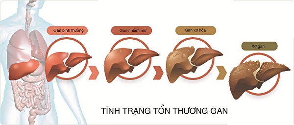 Tác hại của mỡ máu cao